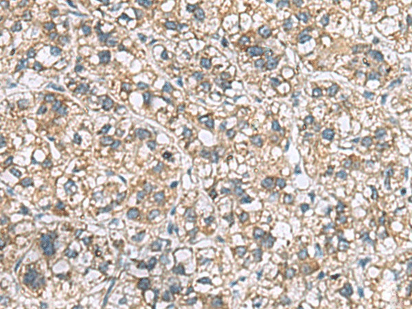 Immunohistochemistry of paraffin-embedded Human liver cancer tissue  using MRPL22 Polyclonal Antibody at dilution of 1:60(?200)