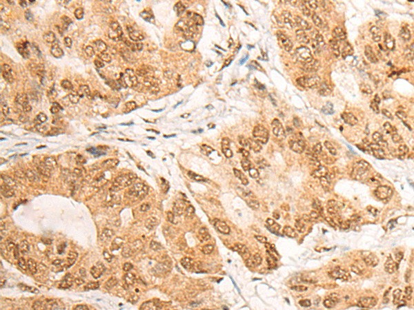 Immunohistochemistry of paraffin-embedded Human gastric cancer tissue  using LPIN1 Polyclonal Antibody at dilution of 1:60(?200)