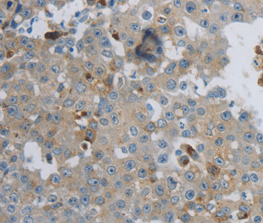 Immunohistochemistry of paraffin-embedded Human breast cancer tissue using CKMT1A Polyclonal Antibody at dilution 1:100