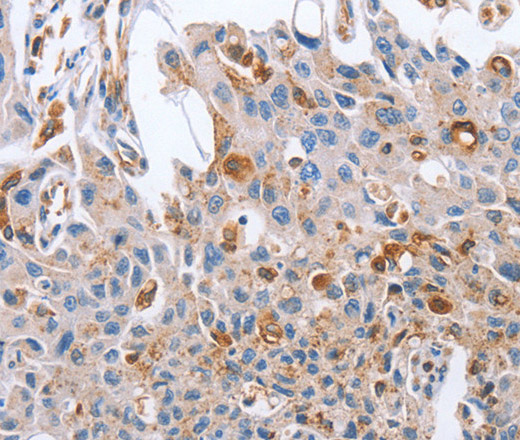 Immunohistochemistry of paraffin-embedded Human lung cancer tissue using NRG4 Polyclonal Antibody at dilution 1:60