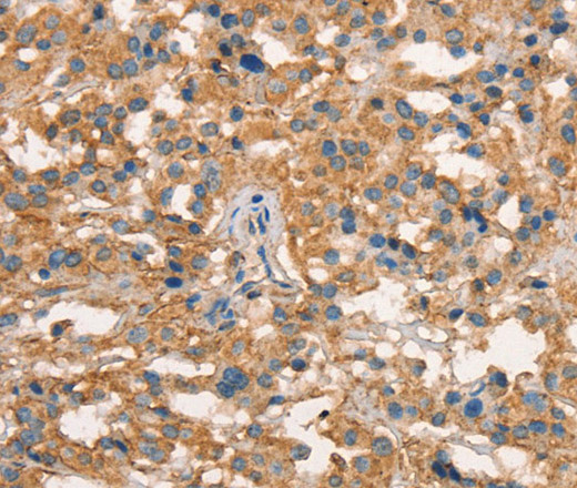 Immunohistochemistry of paraffin-embedded Human thyroid cancer using CD297 Polyclonal Antibody at dilution of 1:50