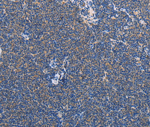 Immunohistochemistry of paraffin-embedded Human Lymphoma using AMY2A Polyclonal Antibody at dilution of 1:60