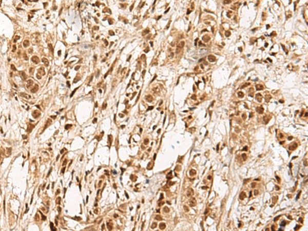 Immunohistochemistry of paraffin-embedded Human breast cancer tissue  using ZBTB43 Polyclonal Antibody at dilution of 1:90(?200)