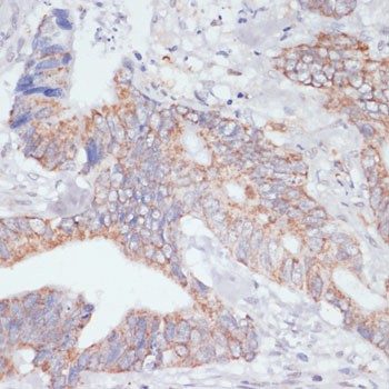 Immunohistochemistry of paraffin-embedded human colon carcinoma using IKKε Polyclonal Antibody at dilution of 1:200 (40x lens).Perform microwave antigen retrieval with 10 mM PBS buffer pH 7.2 before commencing with IHC staining protocol.