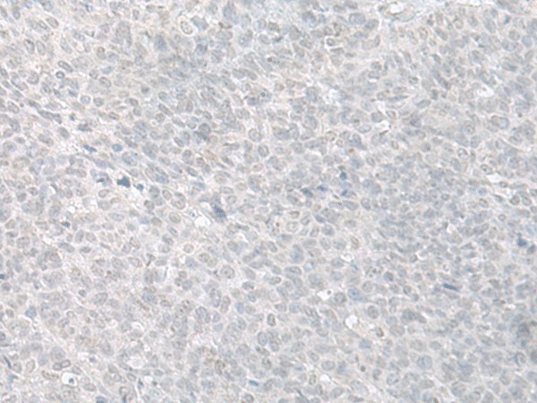 Immunohistochemistry of paraffin-embedded Human ovarian cancer tissue  using C8orf4 Polyclonal Antibody at dilution of 1:70(?200)