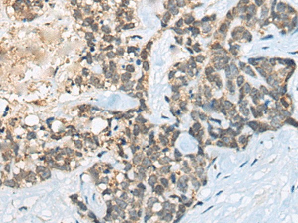 Immunohistochemistry of paraffin-embedded Human thyroid cancer tissue  using BACE2 Polyclonal Antibody at dilution of 1:45(?200)