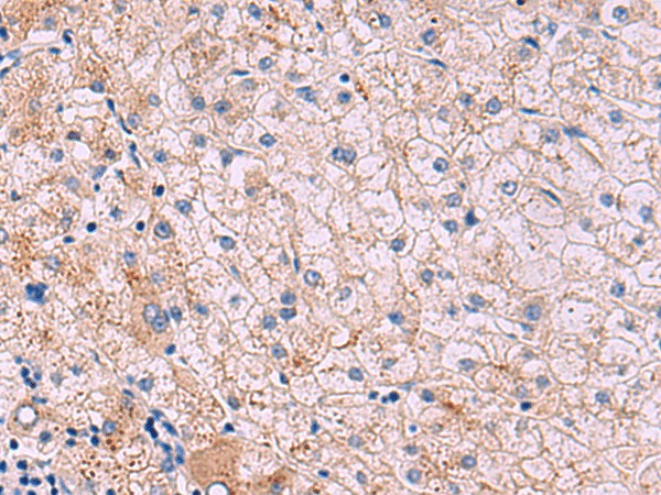 Immunohistochemistry of paraffin-embedded Human liver cancer tissue  using JAM3 Polyclonal Antibody at dilution of 1:40(?200)