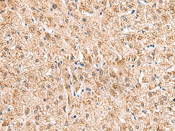 Immunohistochemistry of paraffin-embedded Human liver cancer tissue  using HCCS Polyclonal Antibody at dilution of 1:110(?200)