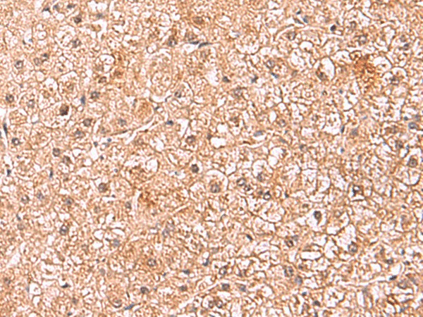 Immunohistochemistry of paraffin-embedded Human liver cancer tissue  using ASTN2 Polyclonal Antibody at dilution of 1:80(?200)