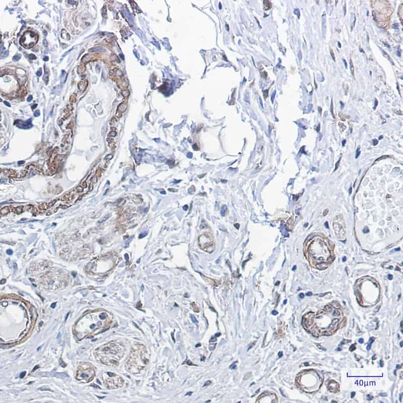 Immunohistochemistry of PPP1CB in paraffin-embedded Human colon cancer tissue using PPP1CB Rabbit mAb at dilution 1:100