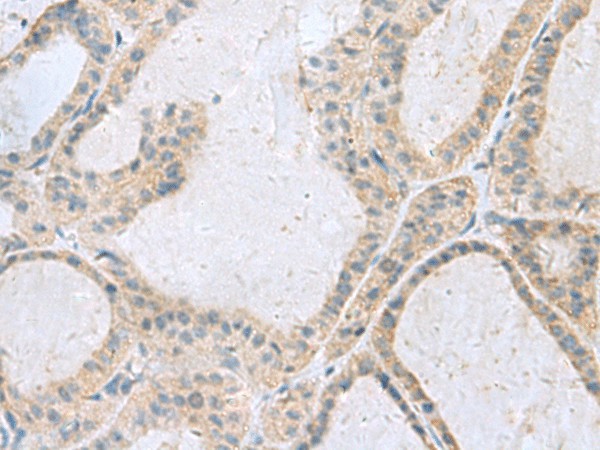 Immunohistochemistry of paraffin-embedded Human thyroid cancer tissue  using GINS3 Polyclonal Antibody at dilution of 1:50(?200)