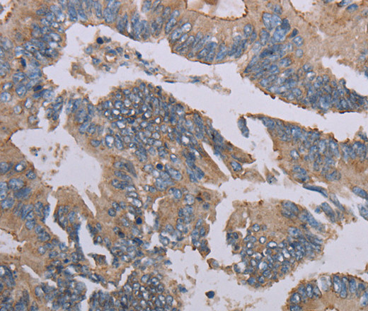 Immunohistochemistry of paraffin-embedded Human colon cancer using MMP20 Polyclonal Antibody at dilution of 1:40