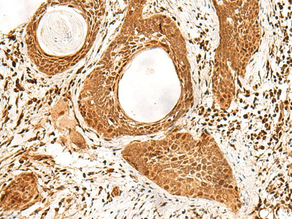 Immunohistochemistry of paraffin-embedded Human esophagus cancer tissue  using ADRM1 Polyclonal Antibody at dilution of 1:70(?200)