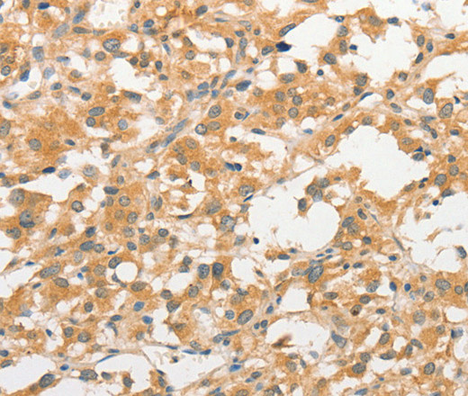 Immunohistochemistry of paraffin-embedded Human thyroid cancer tissue using TLR3 Polyclonal Antibody at dilution 1:40