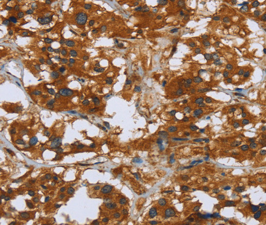 Immunohistochemistry of paraffin-embedded Human thyroid cancer tissue using COMP Polyclonal Antibody at dilution 1:50