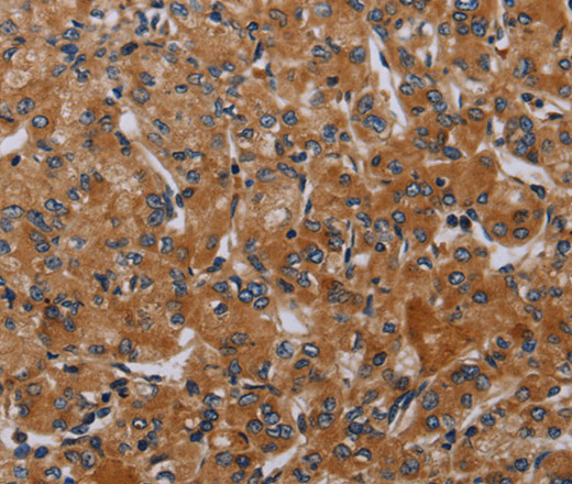 Immunohistochemistry of paraffin-embedded Human prostate cancer using P2RY2 Polyclonal Antibody at dilution of 1:40