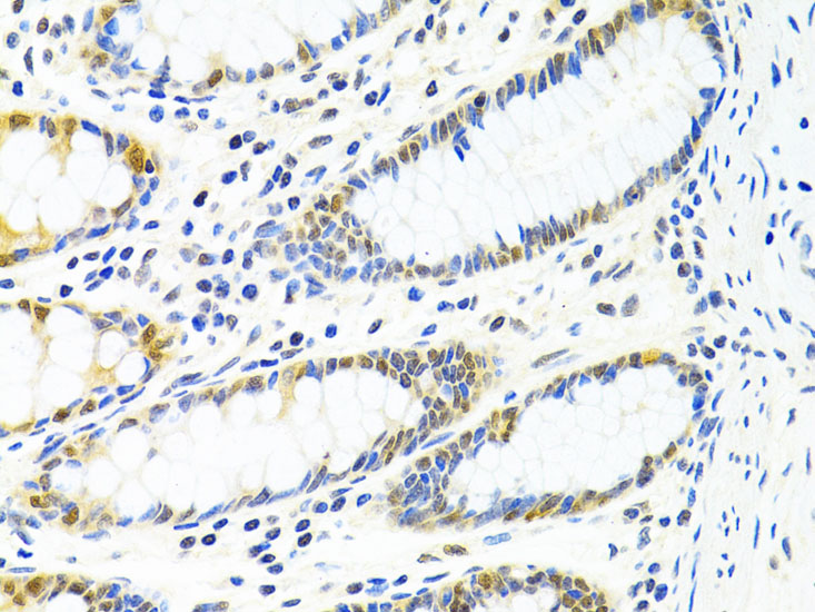 Immunohistochemistry of paraffin-embedded human colon using PPP4C Polyclonal antibody at dilution of 1:100 (40x lens).Perform microwave antigen retrieval with 10 mM PBS buffer pH 7.2 before commencing with IHC staining protocol.