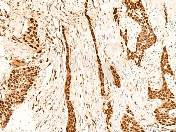 Immunohistochemistry of paraffin-embedded Human esophagus cancer tissue  using METTL1 Polyclonal Antibody at dilution of 1:55(?200)