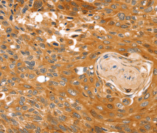 Immunohistochemistry of paraffin-embedded Human esophagus cancer tissue using RGS4 Polyclonal Antibody at dilution 1:25