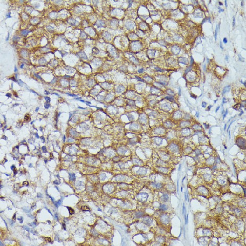 Immunohistochemistry of paraffin-embedded Human mammary cancer using CTTN Polyclonal Antibody at dilution of  1:100 (40x lens).