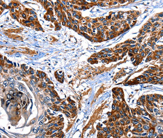 Immunohistochemistry of paraffin-embedded Human esophagus cancer tissue using ITGA7 Polyclonal Antibody at dilution 1:35