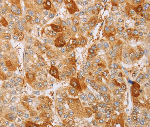 Immunohistochemistry of paraffin-embedded Human liver cancer using CDC46 Polyclonal Antibody at dilution of 1:40