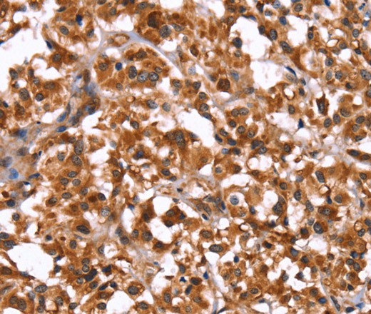 Immunohistochemistry of paraffin-embedded Human thyroid cancer using GUK1 Polyclonal Antibody at dilution of 1:50