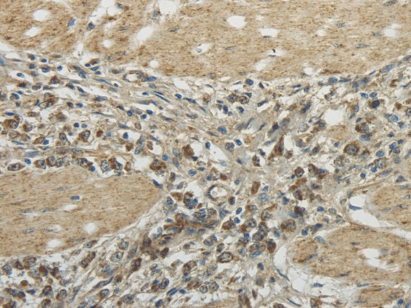 Immunohistochemistry of paraffin-embedded Human gastric cancer tissue using TRIB2 Polyclonal Antibody at dilution 1:45