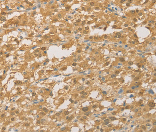 Immunohistochemistry of paraffin-embedded Human thyroid cancer using PGK2 Polyclonal Antibody at dilution of 1:50