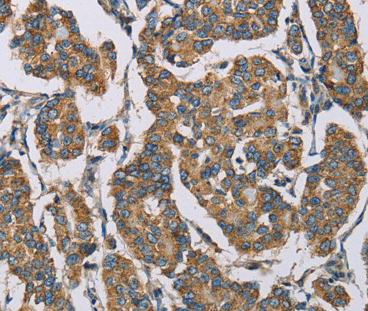 Immunohistochemistry of paraffin-embedded Human breast cancer tissue using HDAC6 Polyclonal Antibody at dilution 1:50