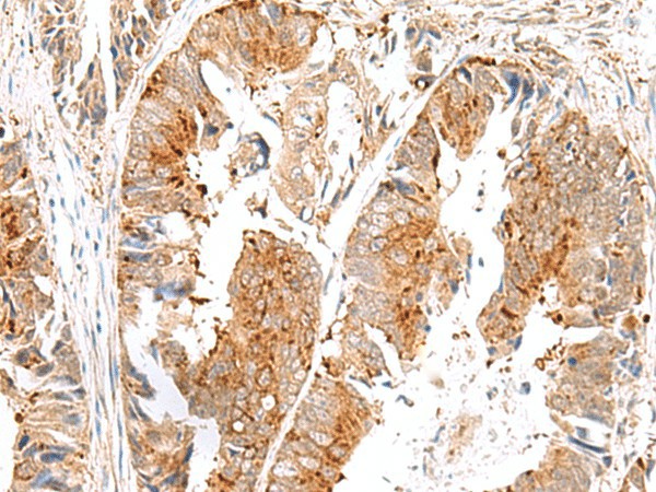 Immunohistochemistry of paraffin-embedded Human colorectal cancer tissue  using SAXO2 Polyclonal Antibody at dilution of 1:45(?200)