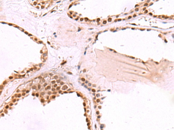 Immunohistochemistry of paraffin-embedded Human thyroid cancer tissue  using RUVBL1 Polyclonal Antibody at dilution of 1:65(?200)