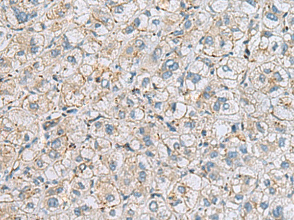 Immunohistochemistry of paraffin-embedded Human liver cancer tissue  using MTHFD2 Polyclonal Antibody at dilution of 1:65(?200)