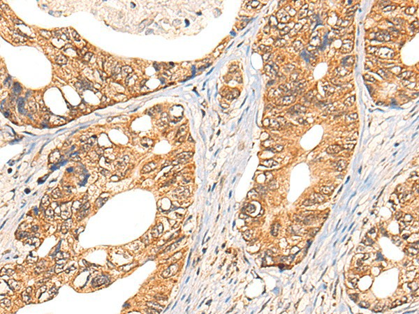 Immunohistochemistry of paraffin-embedded Human gastric cancer tissue  using NOL8 Polyclonal Antibody at dilution of 1:40(?200)