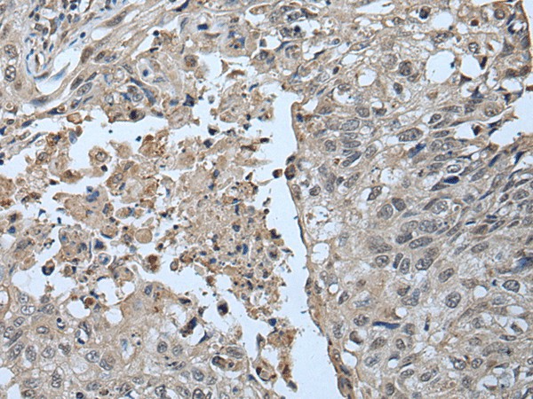 Immunohistochemistry of paraffin-embedded Human lung cancer tissue  using UBR2 Polyclonal Antibody at dilution of 1:55(?200)