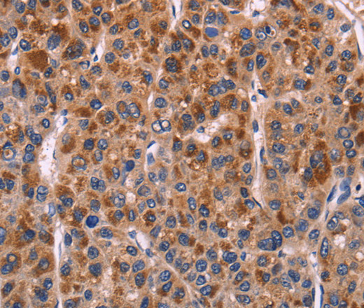 Immunohistochemistry of paraffin-embedded Human liver cancer tissue using SELPLG Polyclonal Antibody at dilution 1:50