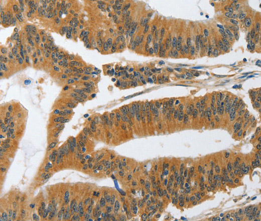 Immunohistochemistry of paraffin-embedded Human colon cancer tissue using PIK3R3 Polyclonal Antibody at dilution 1:45