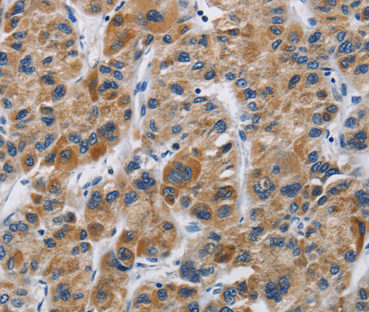 Immunohistochemistry of paraffin-embedded Human liver cancer using IFNGR2 Polyclonal Antibody at dilution of 1:40