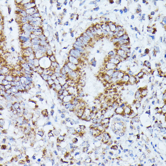 Immunohistochemistry of paraffin-embedded Human colon carcinoma using PPP2CB Polyclonal Antibody at dilution of  1:100 (40x lens).