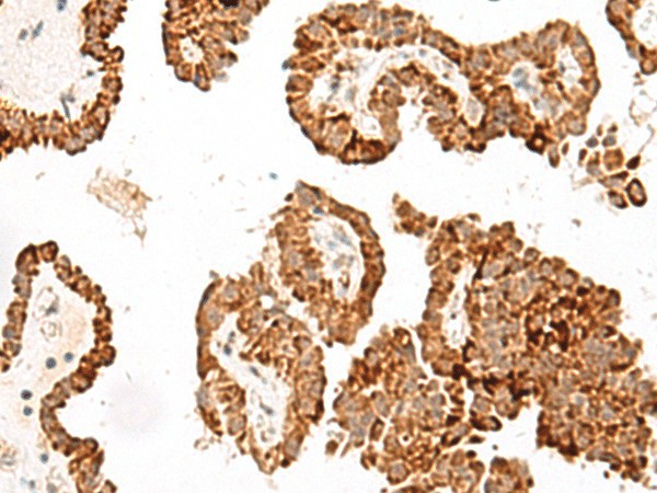 Immunohistochemistry of paraffin-embedded Human thyroid cancer tissue  using GFI1B Polyclonal Antibody at dilution of 1:40(?200)