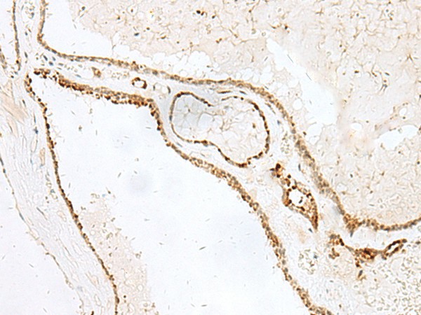 Immunohistochemistry of paraffin-embedded Human thyroid cancer tissue  using GSKIP Polyclonal Antibody at dilution of 1:55(?200)