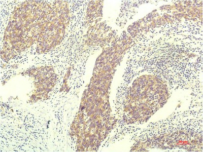 Immunohistochemistry of paraffin-embedded Human breast carcinoma tissue using STAT1 Monoclonal Antibody at dilution of 1:200.