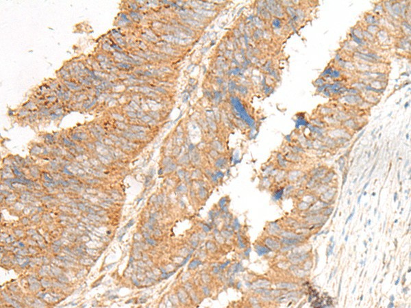 Immunohistochemistry of paraffin-embedded Human colorectal cancer tissue  using GLIS1 Polyclonal Antibody at dilution of 1:50(?200)