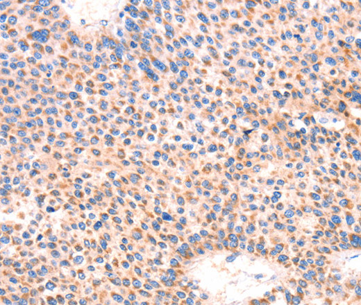 Immunohistochemistry of paraffin-embedded Human liver cancer using AMPD1 Polyclonal Antibody at dilution of 1:70