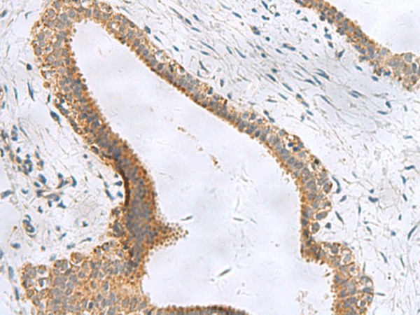 Immunohistochemistry of paraffin-embedded Human breast cancer tissue  using CEMIP Polyclonal Antibody at dilution of 1:120(?200)