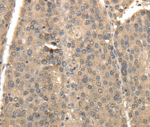 Immunohistochemistry of paraffin-embedded Human liver cancer using TXN Polyclonal Antibody at dilution of 1:40