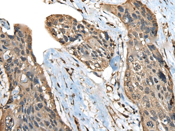 Immunohistochemistry of paraffin-embedded Human esophagus cancer tissue  using ATXN3 Polyclonal Antibody at dilution of 1:100(?200)