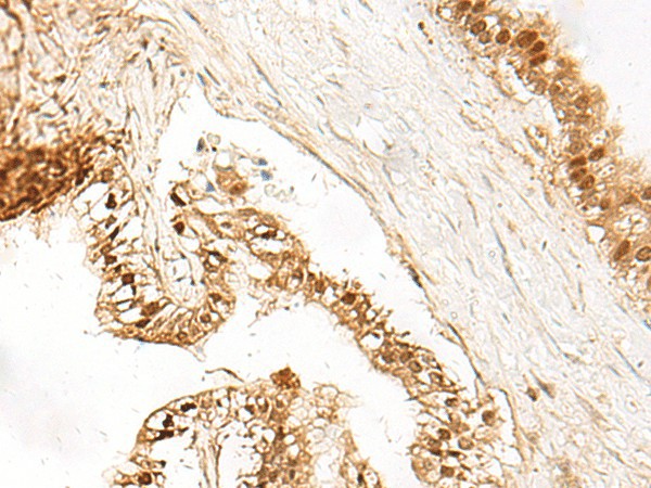 Immunohistochemistry of paraffin-embedded Human liver cancer tissue  using LDHA Polyclonal Antibody at dilution of 1:40(?200)