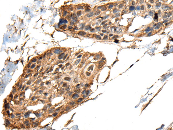 Immunohistochemistry of paraffin-embedded Human esophagus cancer tissue  using MCPH1 Polyclonal Antibody at dilution of 1:40(?200)