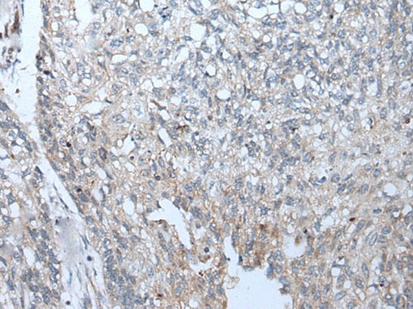 Immunohistochemistry of paraffin-embedded Human lung cancer tissue  using BICD2 Polyclonal Antibody at dilution of 1:70(?200)